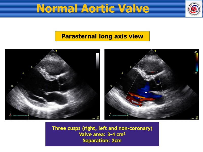Normal Aortic Valve    Parasternal long axis view Three cusps (right, left